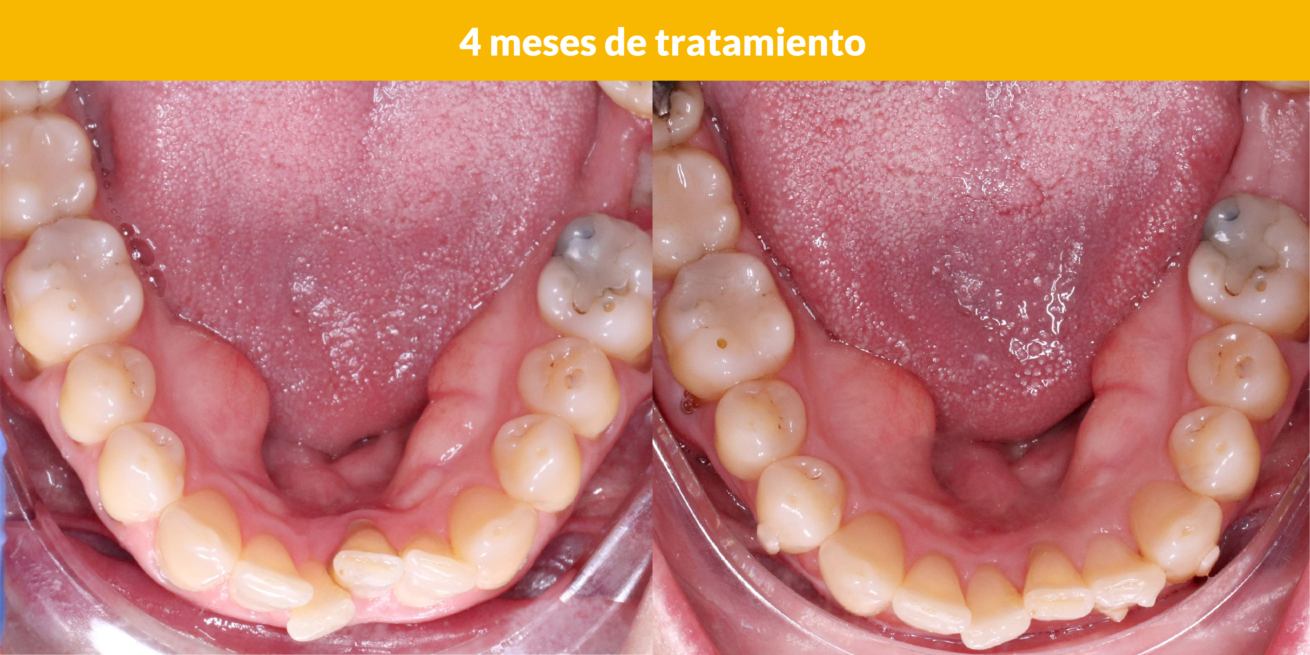 4 meses de tratamiento con ortodoncia invisible
