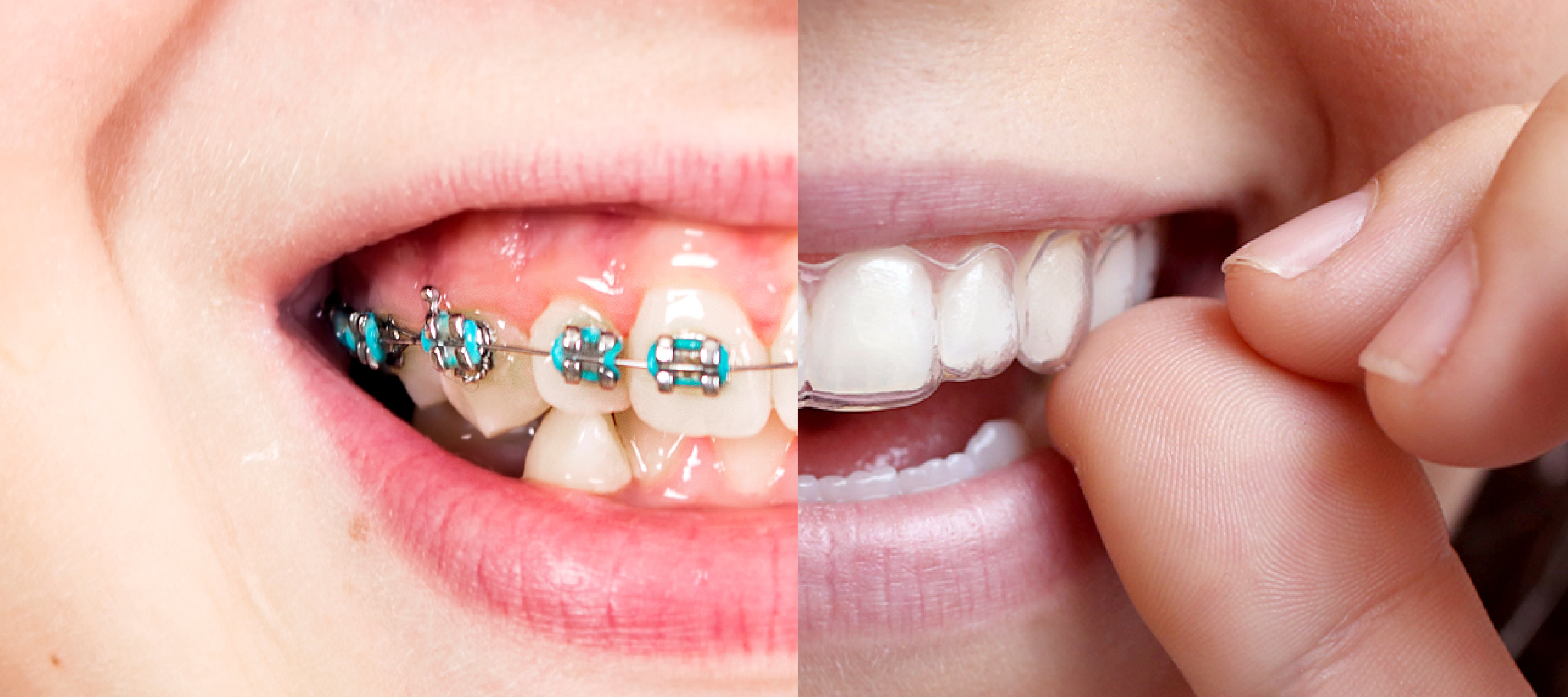 ¿Qué duele más la ortodoncia invisible o los brackets?