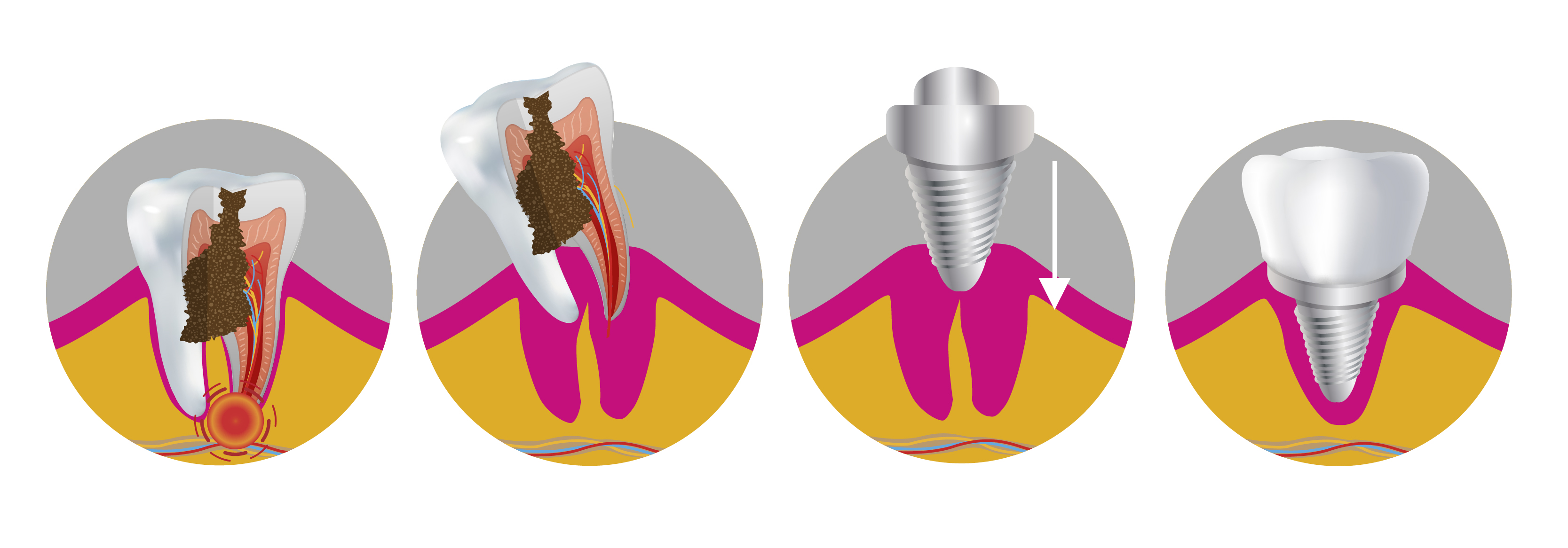 Fase de un implante dental