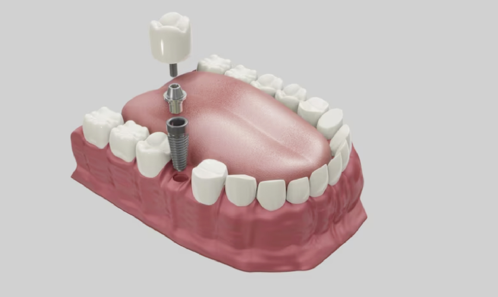 limpiar los implantes dentales