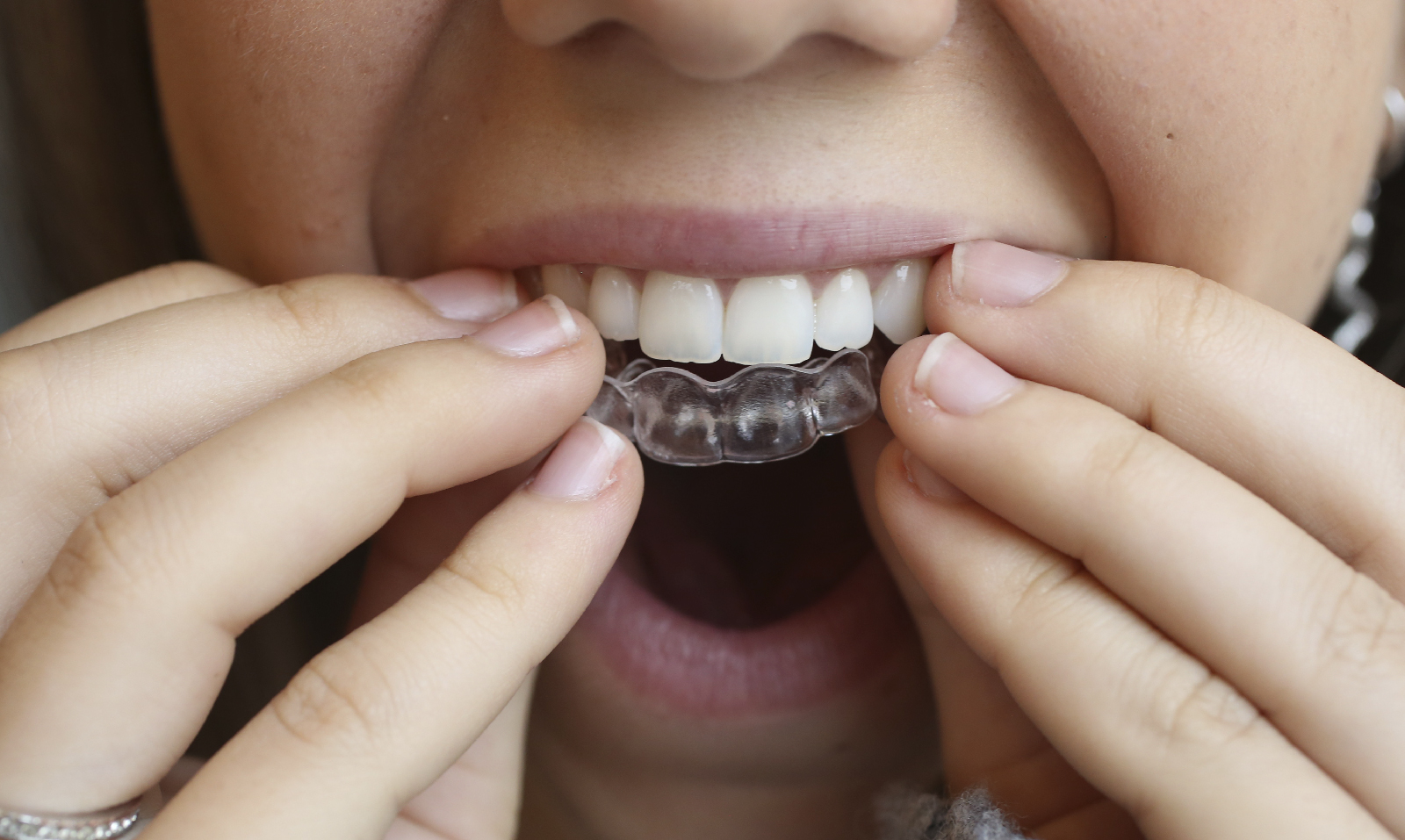 5 preguntas esenciales antes de empezar un tratamiento de ortodoncia
