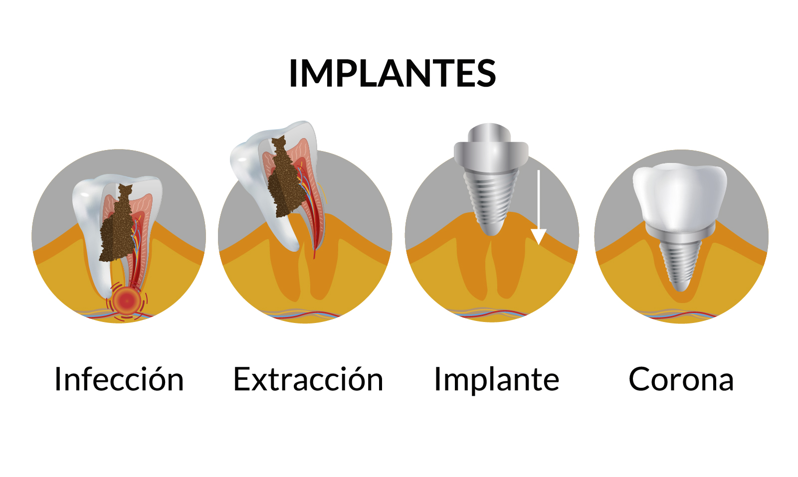 Precio implante dental
