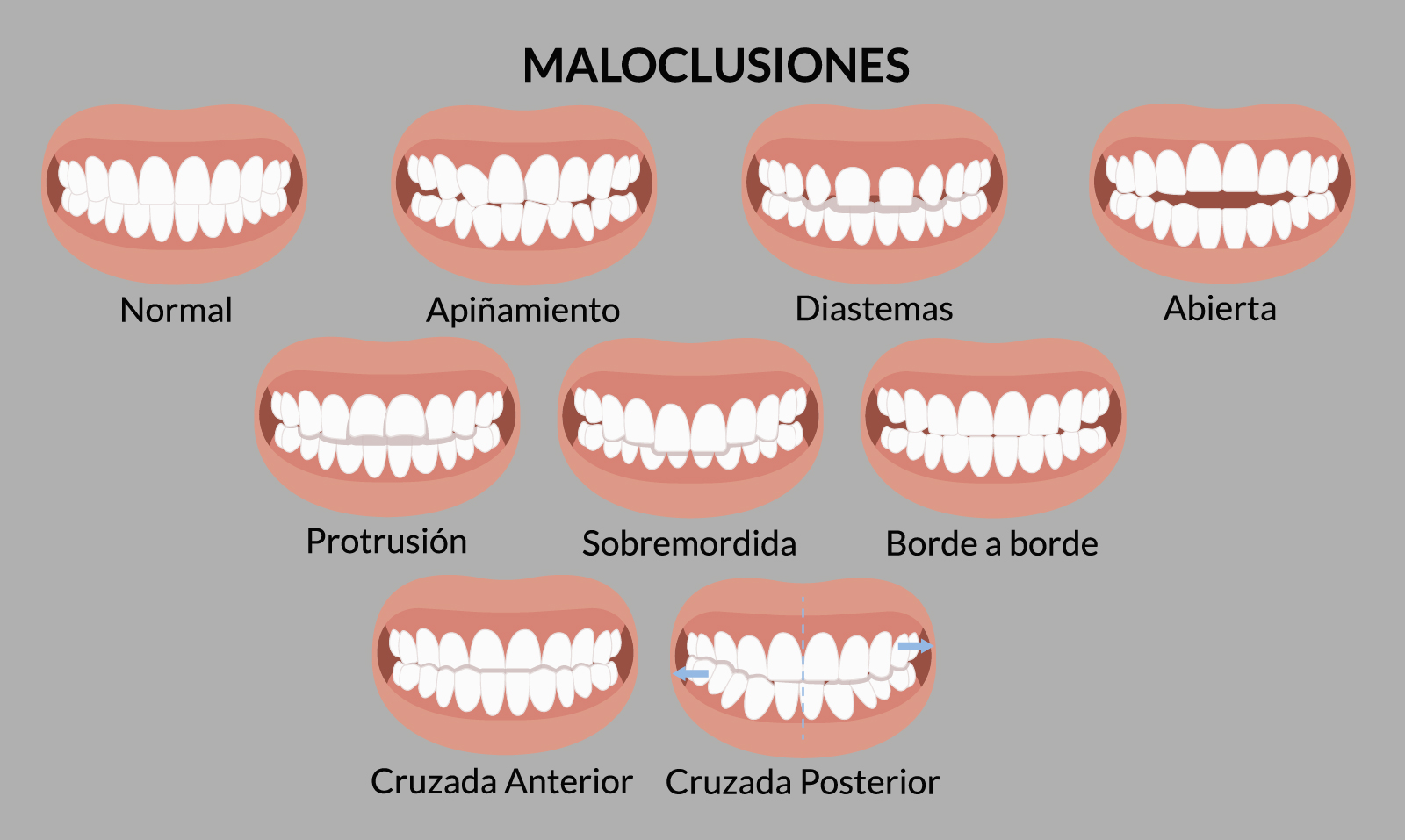 Tipos de maloclusión dental