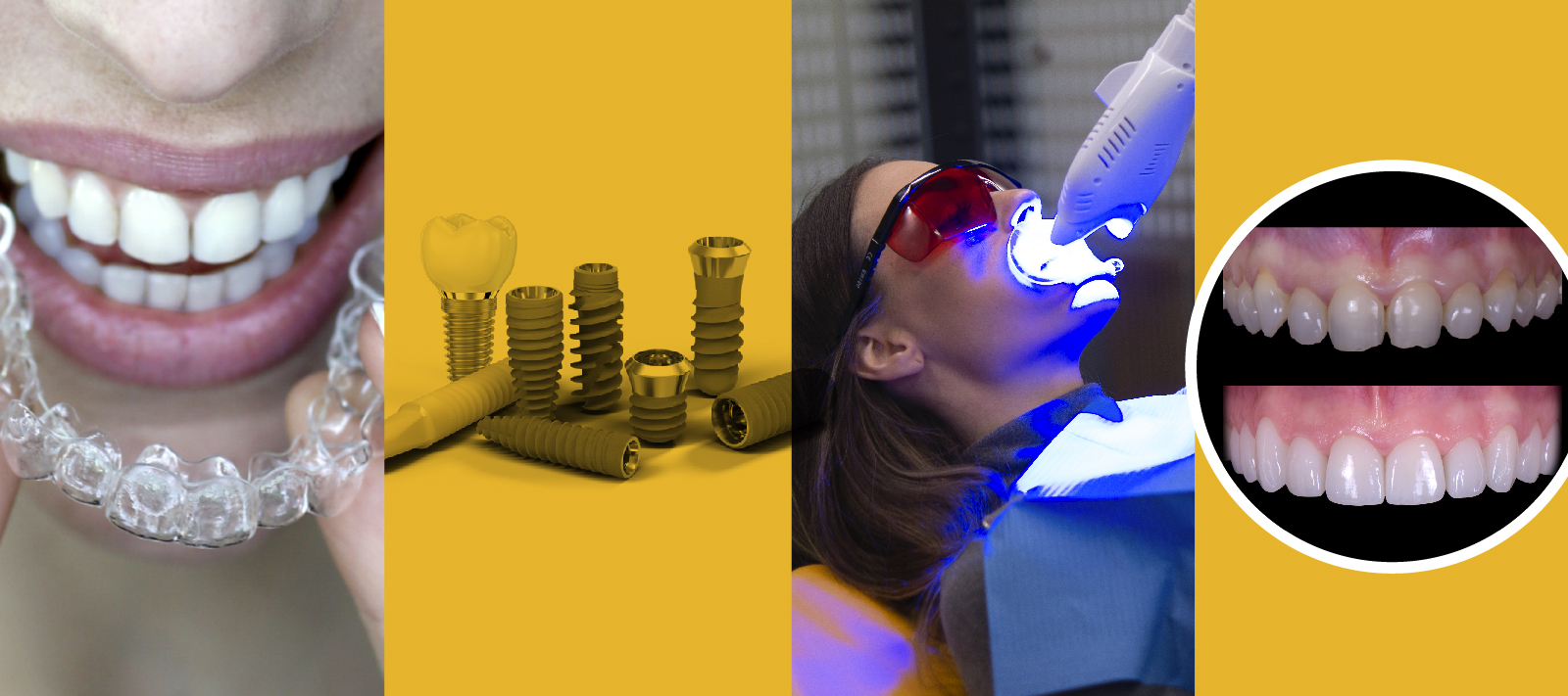 Cuatro tratamientos de odontología estética: Ortodoncia invisible, carillas, implantes y blanqueamiento