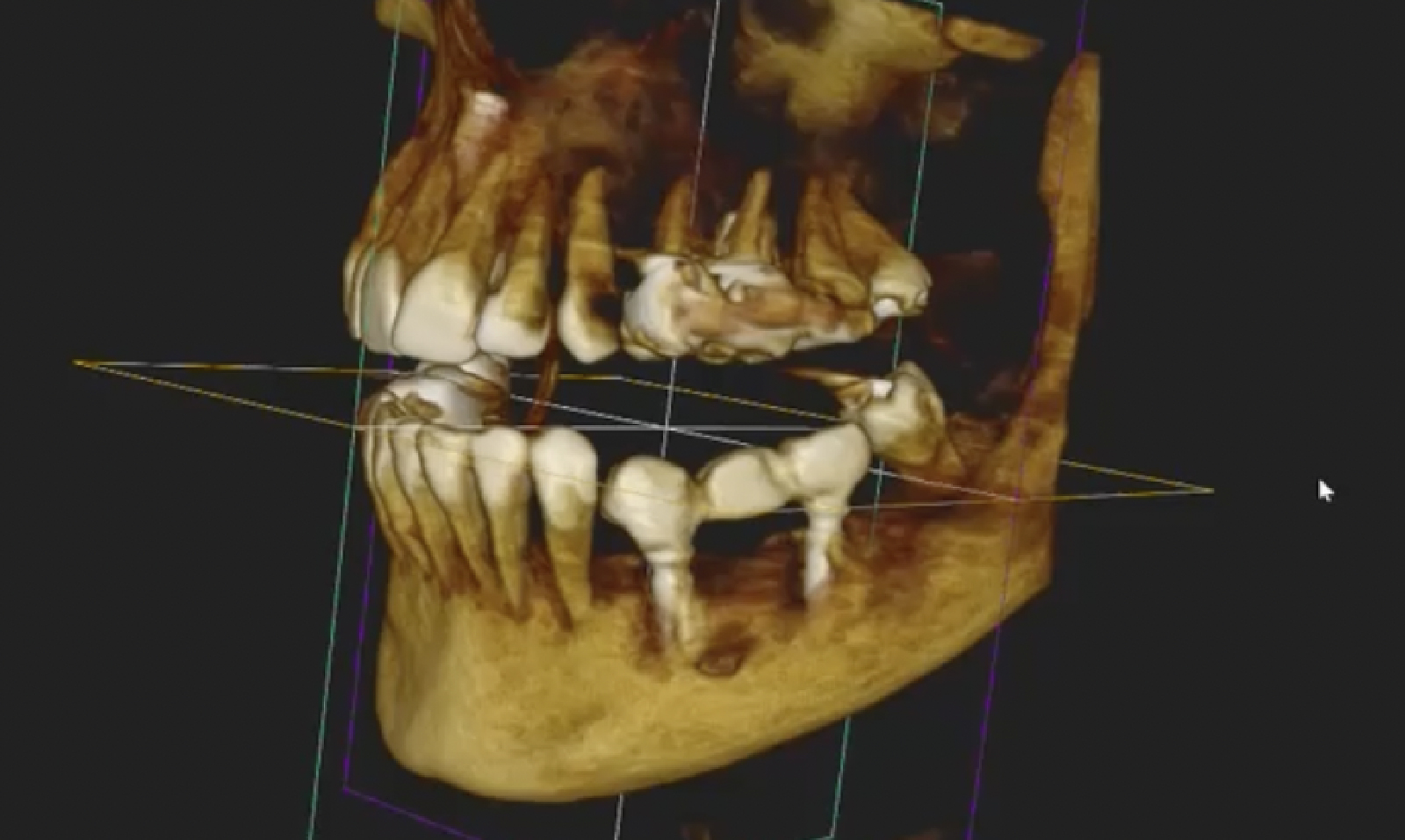 LOS RIESGOS DE UN IMPLANTE DENTAL MAL REALIZADO