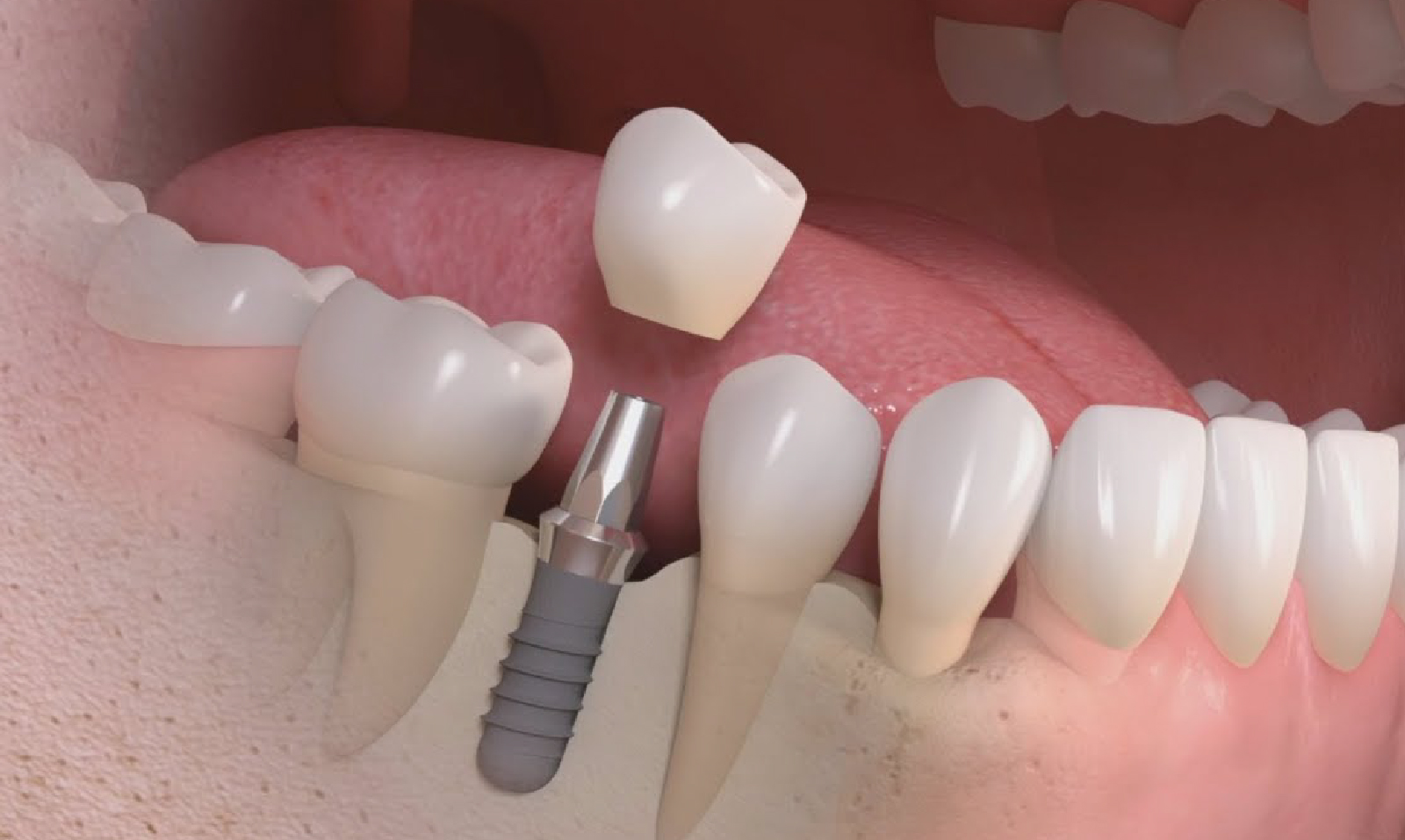 GUÍA COMPLETA SOBRE LOS TIPOS DE IMPLANTES DENTALES