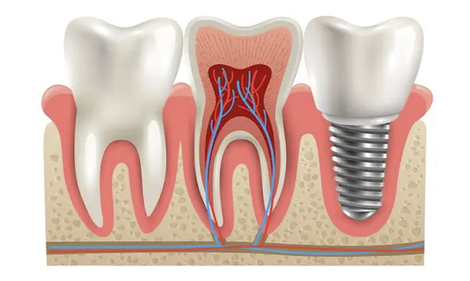 GUÍA COMPLETA SOBRE LOS TIPOS DE IMPLANTES DENTALES