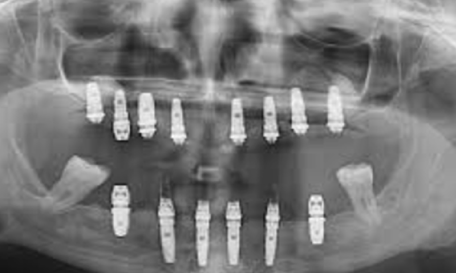 Radiografía en la que se ven los implantes dentales de un paciente