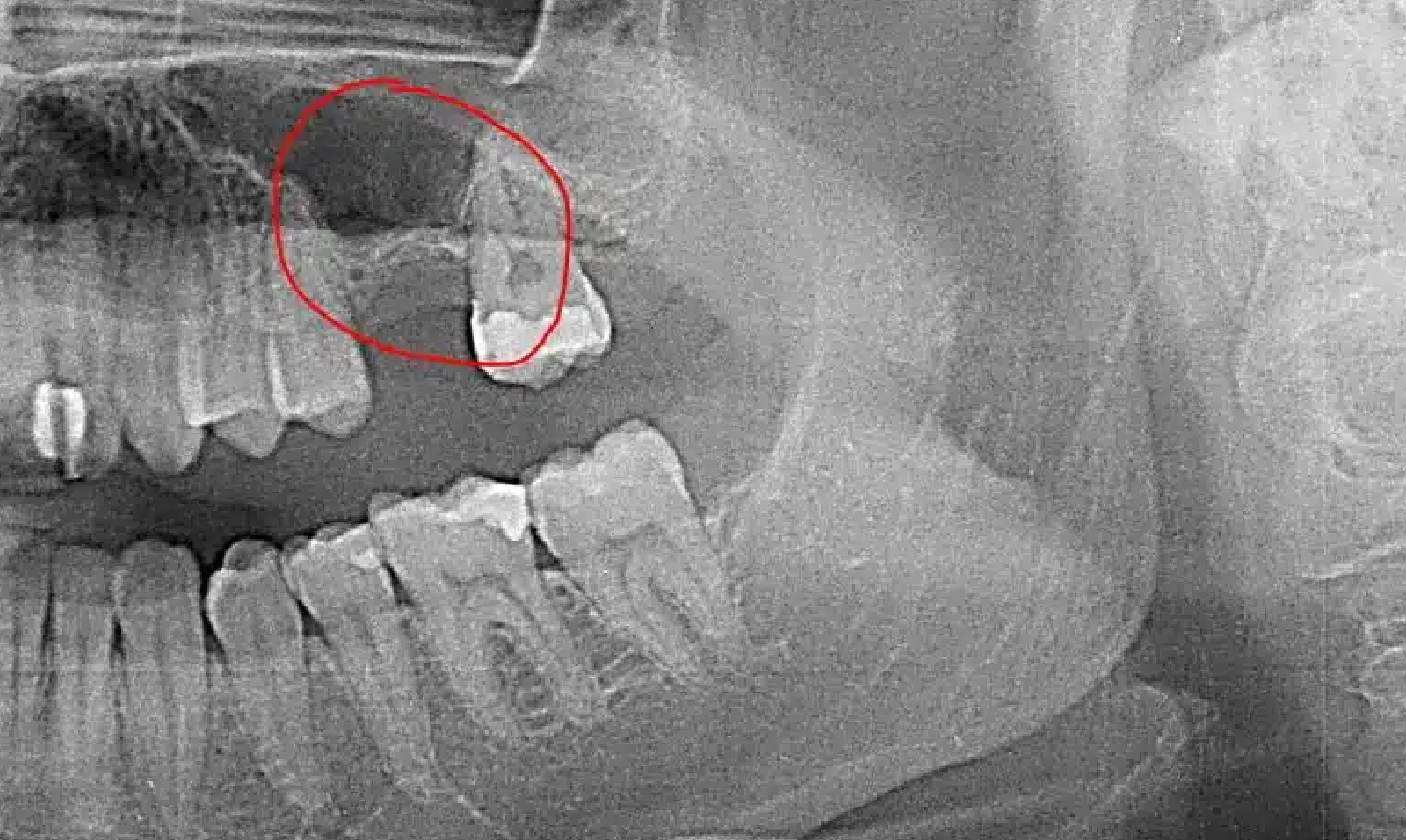 Radiografía utilizada para evaluar la regeneración ósea