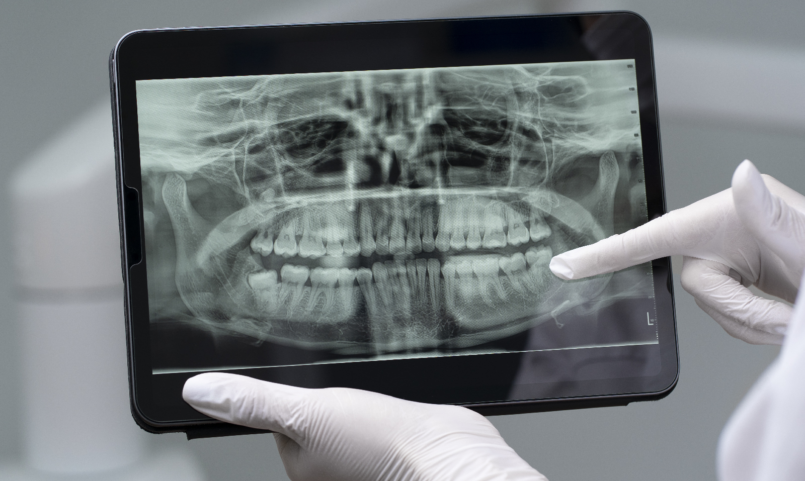 Radiografía de Cirugía oral con poco hueso