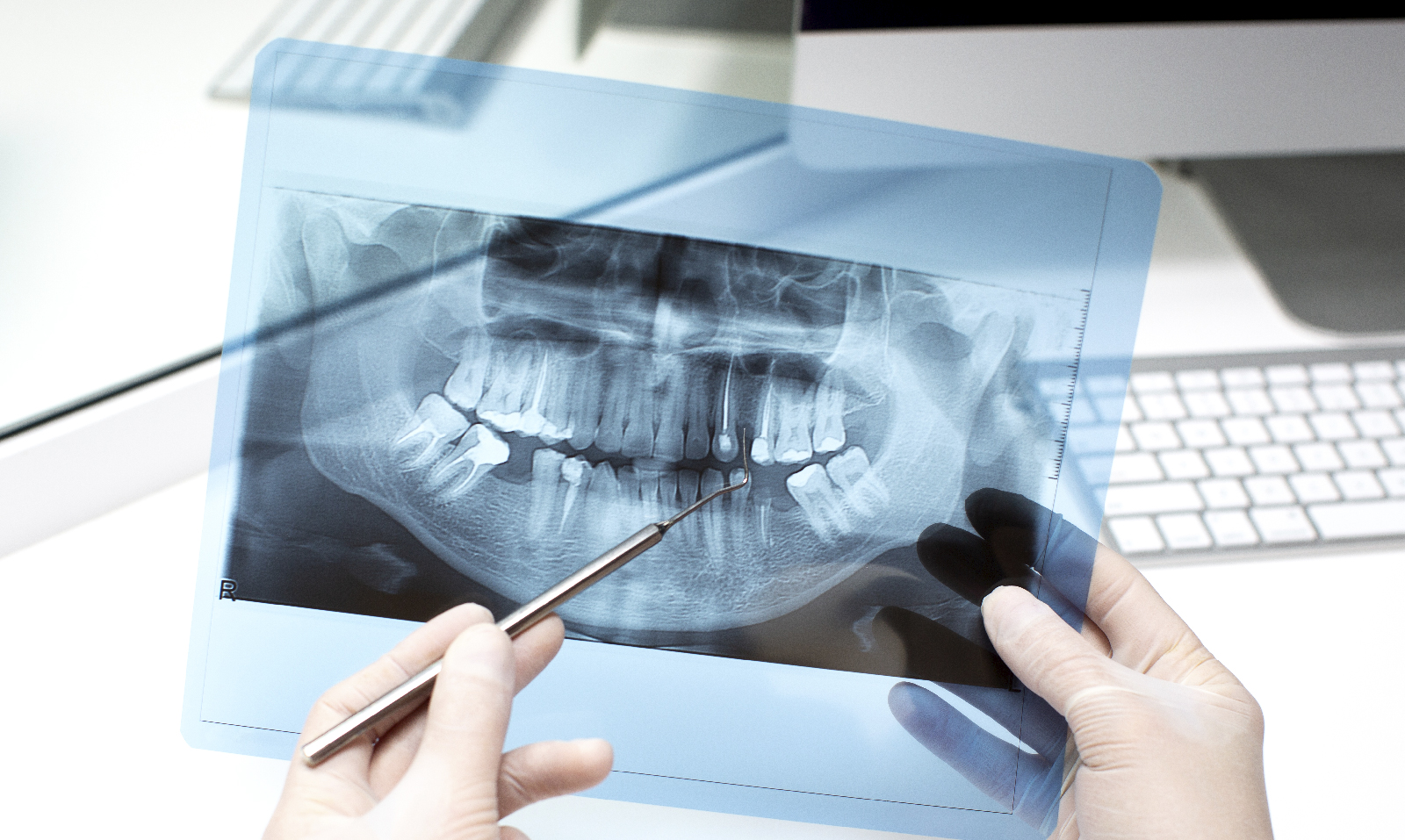Mitos sobre la regeneración ósea dental