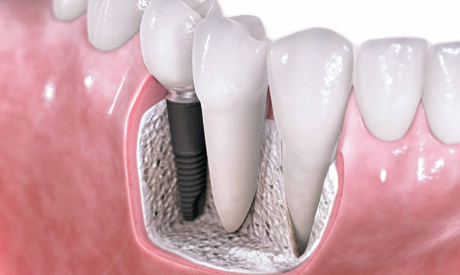 Imagen simulada de regeneración ósea dental