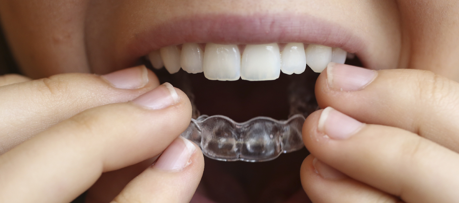 Ortodoncia invisible con implantes