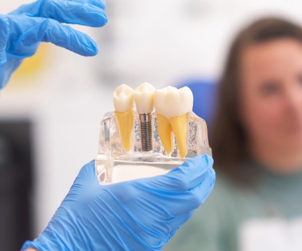 Close-up of dental model with implant. patient of dental clinic on blurred background. dentistry